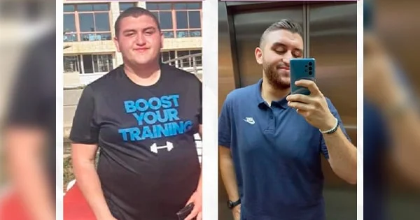 VittaBurn customer Thomas before and after photos